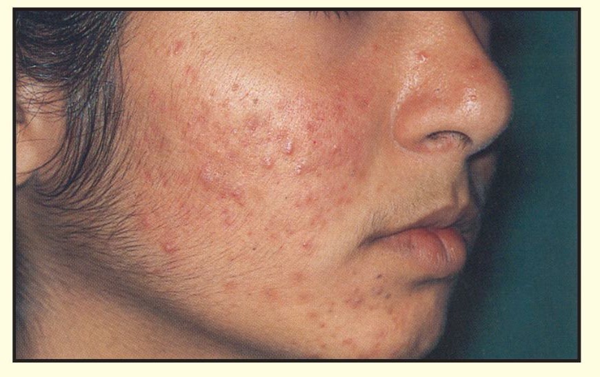 Clinical close-up of a cheek with acne lesions