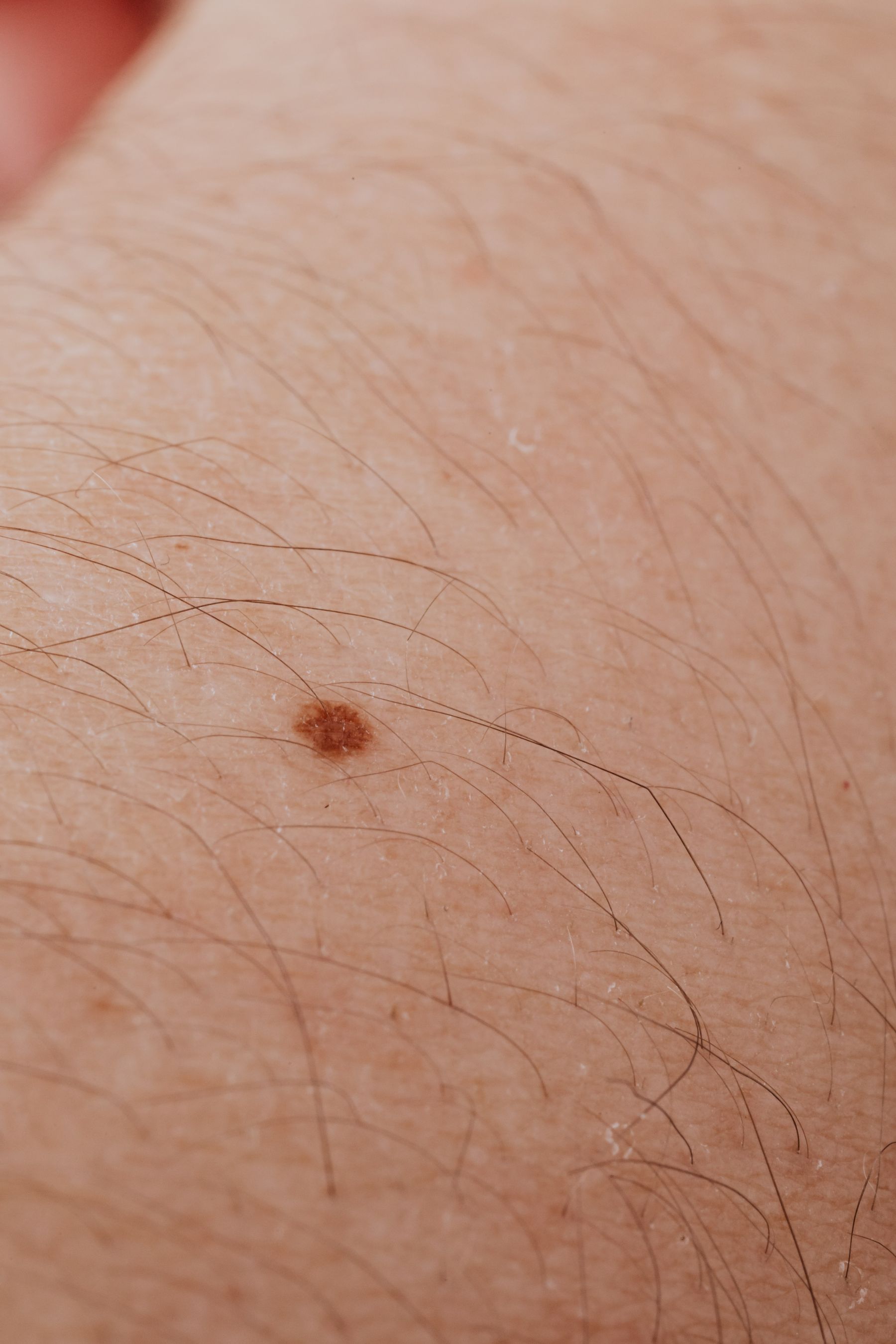 Small brown pigmented spot among hairs on skin
